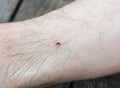 A man has a deer or black-legged tick bite, ixodes scapularis bite on his leg and risks to get infected by lime or borrelia Royalty Free Stock Photo