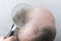 Man has a problem with hair loss.Concept of searching for solution to stop hair loss.Closeup of magnifuing glass above the bald he Royalty Free Stock Photo