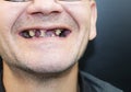 The man has rotten teeth, teeth fell out, yellow and black teeth hurt. Poor teeth condition, erosion, caries. The doctor prepares