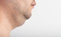 A man has a thick double chin, close-up. Correction and removal of fat from a double chin, plastic surgery. Copy space Royalty Free Stock Photo