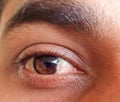 A man have pterygium is in the eye. Royalty Free Stock Photo