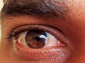 A man have pterygium is in the eye. Royalty Free Stock Photo