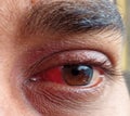 A man have pterygium is in the eye. Royalty Free Stock Photo