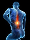 A man having acute back pain