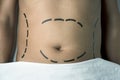 Man having a plastic surgery or a liposuction