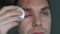 Man with herpes zoster on his face treats purulent blisters with a cotton pad