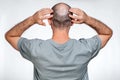 A man holds his hands over his bald head, demonstrating focal alopecia. Rear view. The concept of baldness and male alopecia