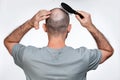 A man holds his hands to his bald head, combing alopecia foci with a comb. Rear view. The concept of baldness and male alopecia