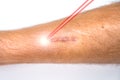 Man leg and laser beam during scar removal treatment. Laser resurfacing of scars