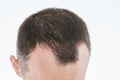 Man loosing hair theme Royalty Free Stock Photo