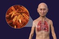 A man with the lungs affected by cavernous tuberculosis, and close-up view of Mycobacterium tuberculosis bacteria, 3D