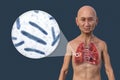 A man with the lungs affected by cavernous tuberculosis, and close-up view of Mycobacterium tuberculosis bacteria, 3D