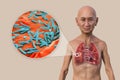 A man with the lungs affected by cavernous tuberculosis, and close-up view of Mycobacterium tuberculosis bacteria, 3D
