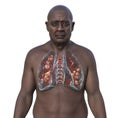 A man with lungs affected by cystic fibrosis, 3D illustration