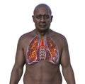 A man with lungs affected by cystic fibrosis, 3D illustration