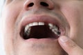 Man With Missing Tooth Royalty Free Stock Photo