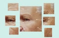 Man Of Old Wrinkles On Face Before After Therapy Dermatology Medicine Filler Collagen Hydrating Removal, Aging Procedures