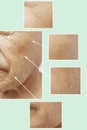 Man of old wrinkles on face before after operation surger medicine filler collagen hydrating removal, aging procedures Royalty Free Stock Photo