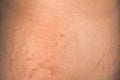 A man is overweight all over his body, on his stomach, chest, arms. Stretch marks on the abdomen in the process of losing weight Royalty Free Stock Photo