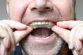 Man placing a bite plate in his mouth Royalty Free Stock Photo