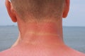 The man received sunburn on seashore. The skin peels off. Protection of the skin from the sun. Royalty Free Stock Photo