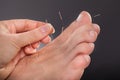 Man receiving acupuncture treatment