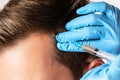 Man receiving scalp injection for hair grow