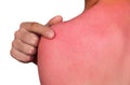 A man with reddened, itchy skin after sunburn. Royalty Free Stock Photo