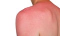 Man with reddened, itchy skin after sunburn. Royalty Free Stock Photo