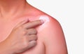 A man with reddened, itchy skin after sunburn. Skin care and protection from the sun`s ultraviolet rays. Cosmetology concept