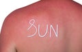 Man with reddened, itchy skin after sunburn. Cream on the back. Royalty Free Stock Photo