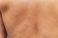 A man`s back bite of a mosquito on the background of a mall. Royalty Free Stock Photo