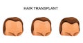 Man`s hair transplant