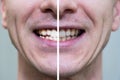 Man`s smile before and after bleaching. Dental health care and whitening teeth Royalty Free Stock Photo