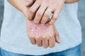 Man scratch oneself, dry flaky skin on hand with psoriasis vulgaris, eczema and other skin conditions like fungus, plaque, rash an Royalty Free Stock Photo