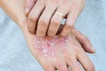 Man scratch oneself, dry flaky skin on hand with psoriasis vulgaris, eczema and other skin conditions like fungus, plaque, rash an Royalty Free Stock Photo