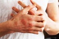 Man scratch oneself, dry flaky skin on hand with psoriasis vulgaris, eczema and other skin conditions like fungus