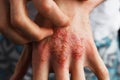 Man scratch oneself, dry flaky skin on hand with psoriasis vulgaris, eczema and other skin conditions like fungus Royalty Free Stock Photo