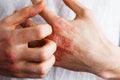 Man scratch oneself, dry flaky skin on hand with psoriasis vulgaris, eczema and other skin conditions like fungus