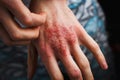 Man scratch oneself, dry flaky skin on hand with psoriasis vulgaris, eczema and other skin conditions like fungus Royalty Free Stock Photo