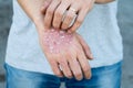 Man scratch oneself, dry flaky skin on hand with psoriasis vulgaris, eczema and other skin conditions like fungus, plaque, rash an Royalty Free Stock Photo