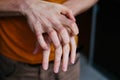 Man scratch oneself, dry flaky skin on hand with psoriasis vulgaris, eczema and other skin conditions like fungus Royalty Free Stock Photo