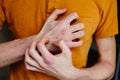 Man scratch oneself, dry flaky skin on hand with psoriasis vulgaris, eczema and other skin conditions like fungus, plaque, rash Royalty Free Stock Photo