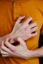 Man scratch oneself, dry flaky skin on hand with psoriasis vulgaris, eczema and other skin conditions like fungus, plaque, rash