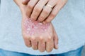 Man scratch oneself, dry flaky skin on hand with psoriasis vulgaris, eczema and other skin conditions like fungus, plaque, rash an