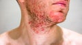 Man with seborrheic dermatitis in the beard area