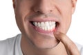 Man showing inflamed gums on white background, closeup Royalty Free Stock Photo