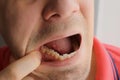 Man is showing tooth in mouth with dental abscess fistula on gum, closeup view.