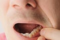 Man is showing tooth in mouth with dental abscess fistula on gum, closeup view.