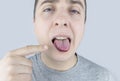 Black tongue. A man shows the consequences of an injury, bite or burn of the tongue. Part is damaged. Treatment of internal